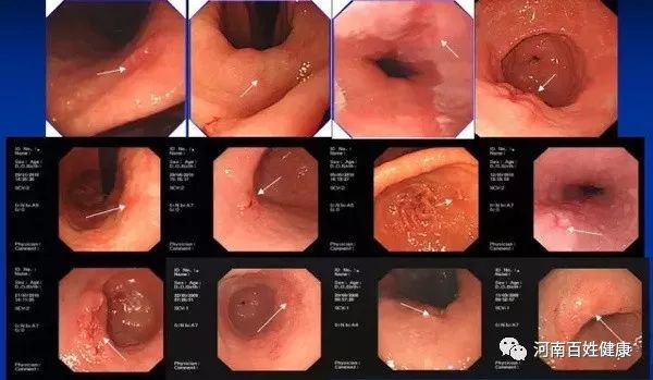 最新胃腸鏡技術，醫(yī)學領域的革新之星